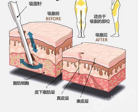 抽脂減肥方法原理,抽脂減肥方法原理是什麽