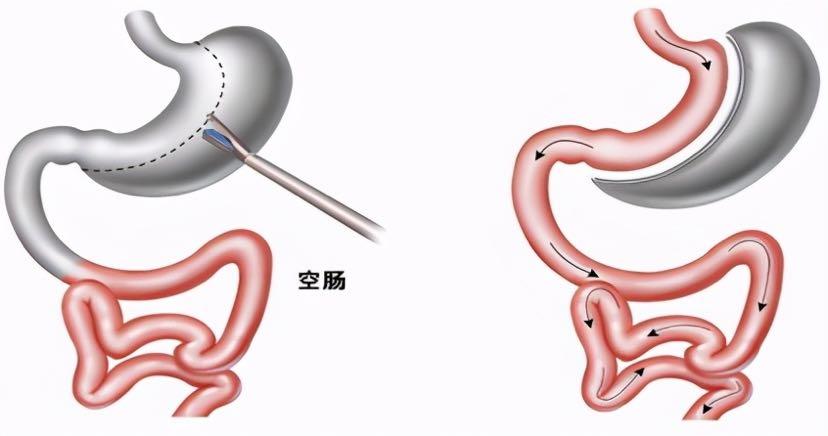 減肥手術(shù)方法有哪些,減肥手術(shù)方法有哪些圖片